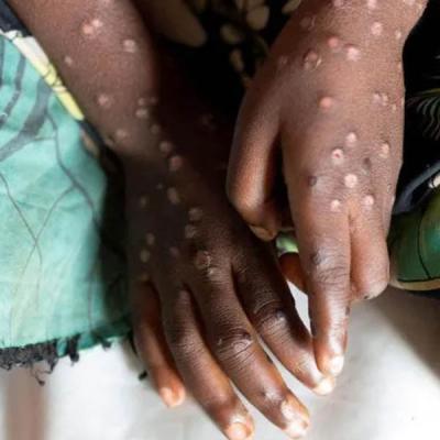 Mpox ගැන සෞඛ්‍ය අමාත්‍යාංශයෙන් දැනුම්දීමක්